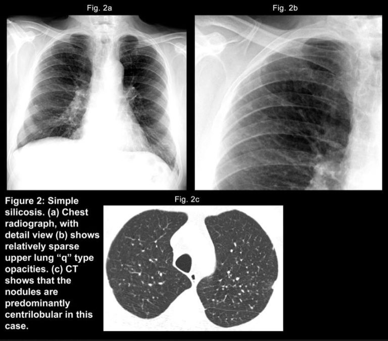 What Is Silicosis And How Is It Contracted?